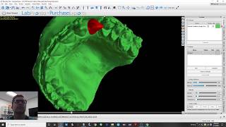 Blue Sky Bio  Single Implant Surgical Guide Design [upl. by Regor]