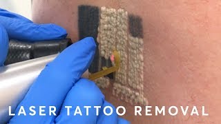 Laser Tattoo Removal PAIN RESULTS amp PROCEDURE [upl. by Winwaloe]