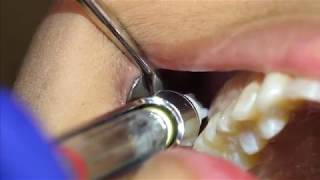 Posterior Superior Alveolar PSA Injection Demonstration and Overview 4K [upl. by Tallula706]