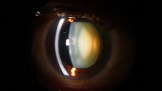 Slit Lamp examination of the anterior segment of the eye [upl. by Seuqcaj]