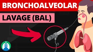 Bronchoalveolar Lavage BAL Medical Definition  Quick Explainer Video [upl. by Ytsim]