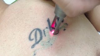 Tattoo Removal using Spectra Laser  Los Angeles Skin Perfect Brothers [upl. by Amis]