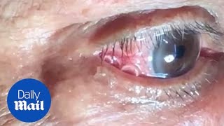 GRAPHIC Moment 15cm long worm is removed from mans eye [upl. by Enyrhtac577]