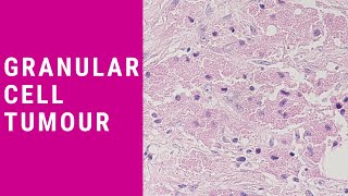 Granular Cell Tumour  Pathology mini tutorial [upl. by Delija451]