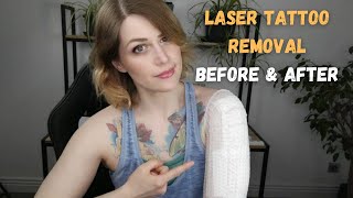 Laser Tattoo Removal Before amp After [upl. by Natsreik376]